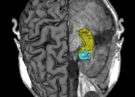 A scan of the brain, on the left showing the surface structure and on the right showing a specific internal area highlighted in yellow and blue.