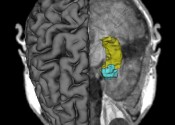 A scan of the brain, on the left showing the surface structure and on the right showing a specific internal area highlighted in yellow and blue.